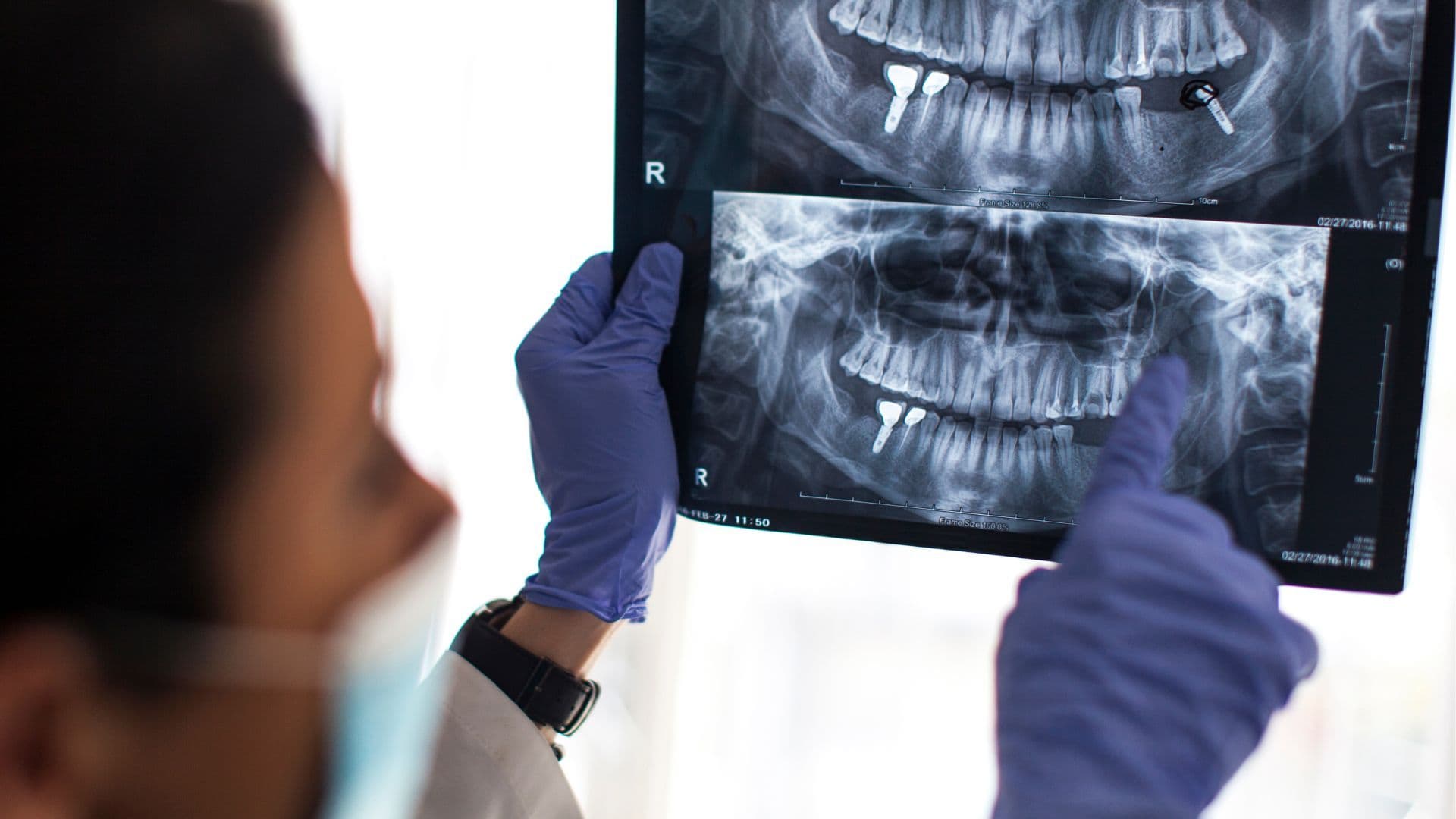 Implantul dentar, pas cu pas: ghidul pacientului
